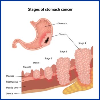 Stomach Disease - Kaizen Hospital | Peptic Ulcer Treatment | Stomach Cancer