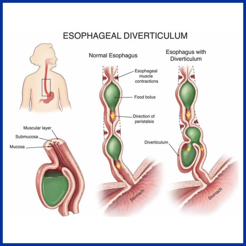 Symptoms Of Esophagus Diseases | Gastro Esophageal Reflux Disease (GERD ...