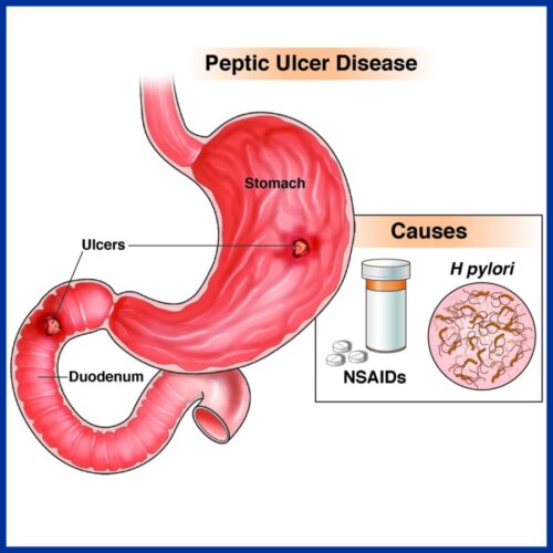 Stomach Disease - Kaizen Hospital | Peptic Ulcer Treatment | Stomach Cancer