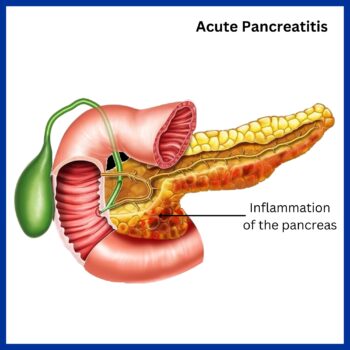 Pancreas Disease - Kaizen Hospital | Pancreatic Cancer Treatment