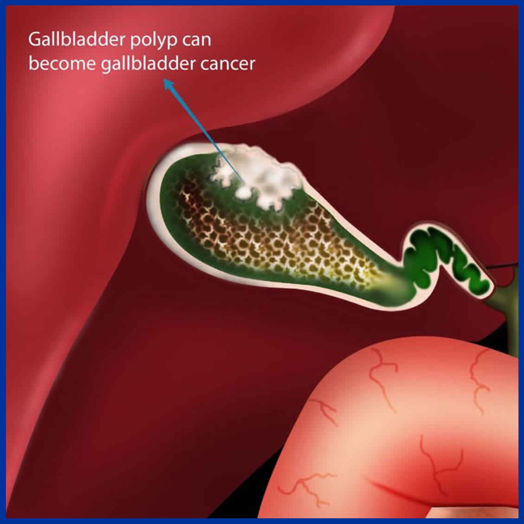 Gall Bladder Disease – Kaizen Hospital | Gall Bladder Cancer