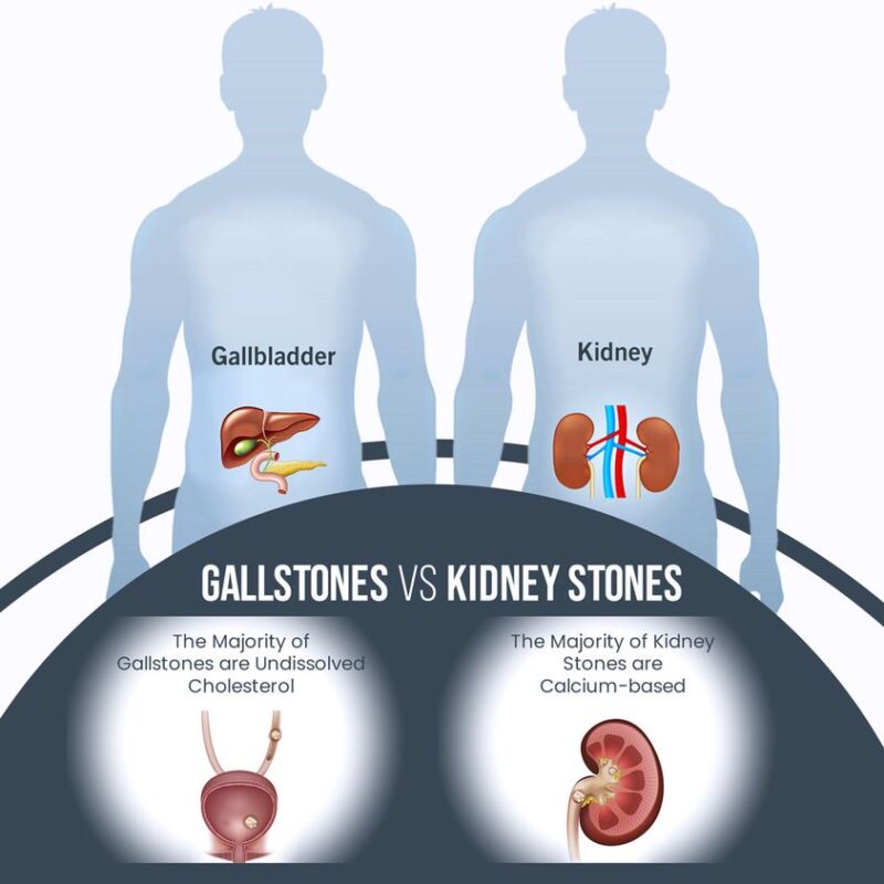 gallstone kidney stone