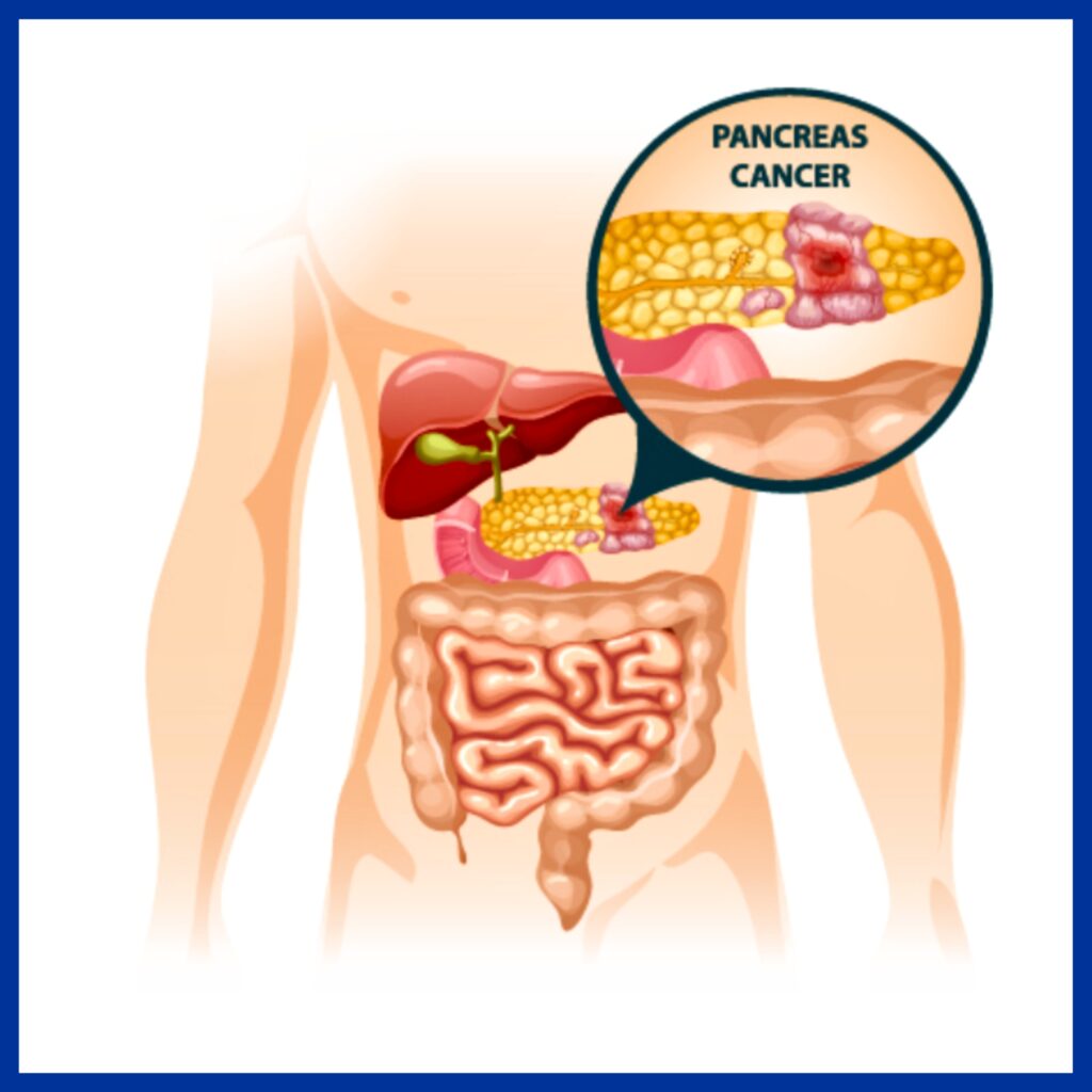 Cancer of Pancreas