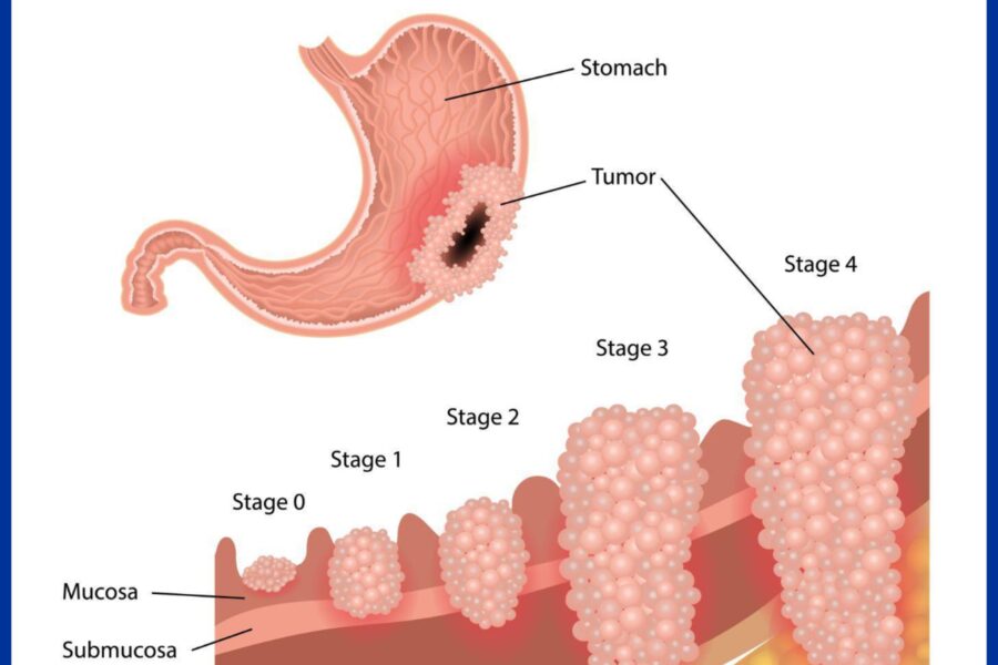 Cancer of Stomach