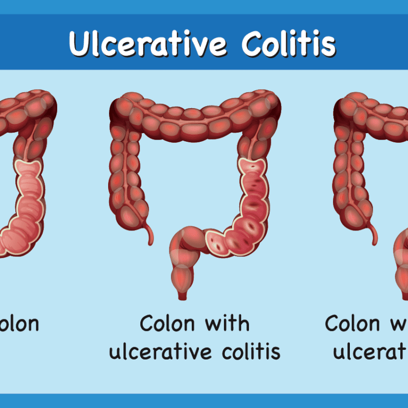 Ulcerative Colitis