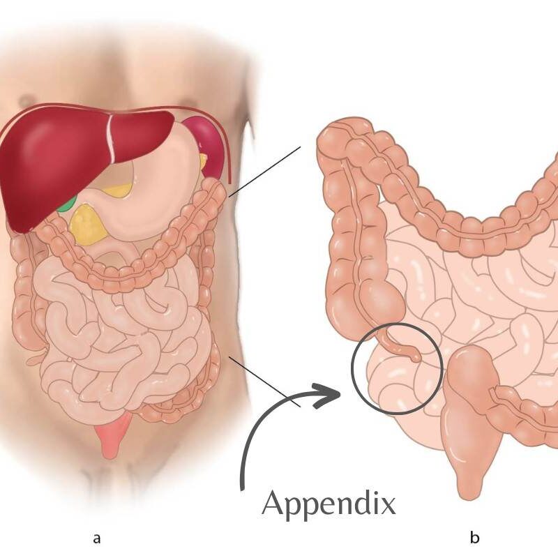 Appendix Diseases