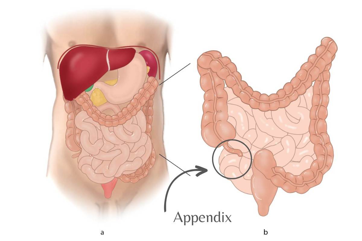 What is appendix disease?