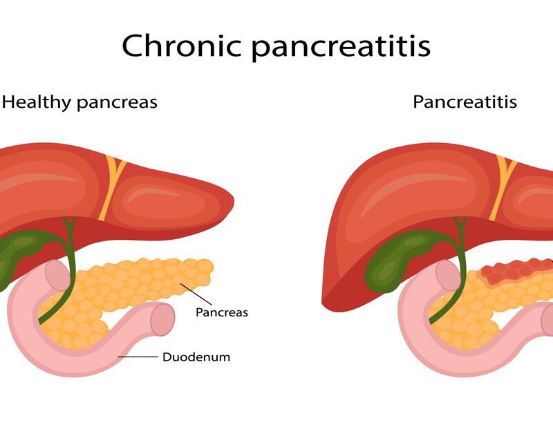 pancreatitis disease