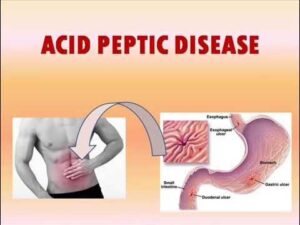 acid peptic