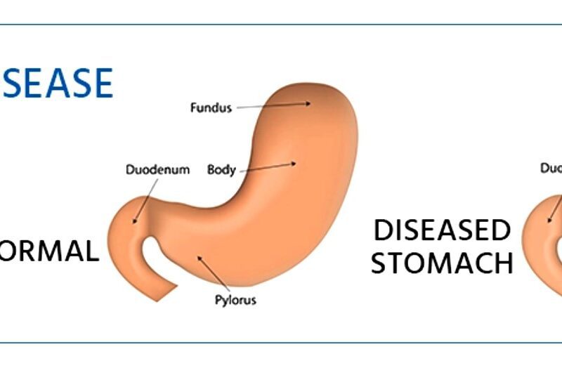 Crohn’s Disease