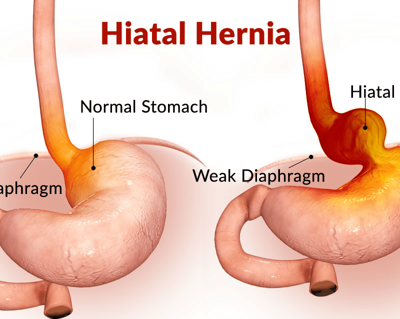 HIATUS HERNIA