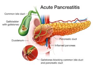 Acute pancreatitis 